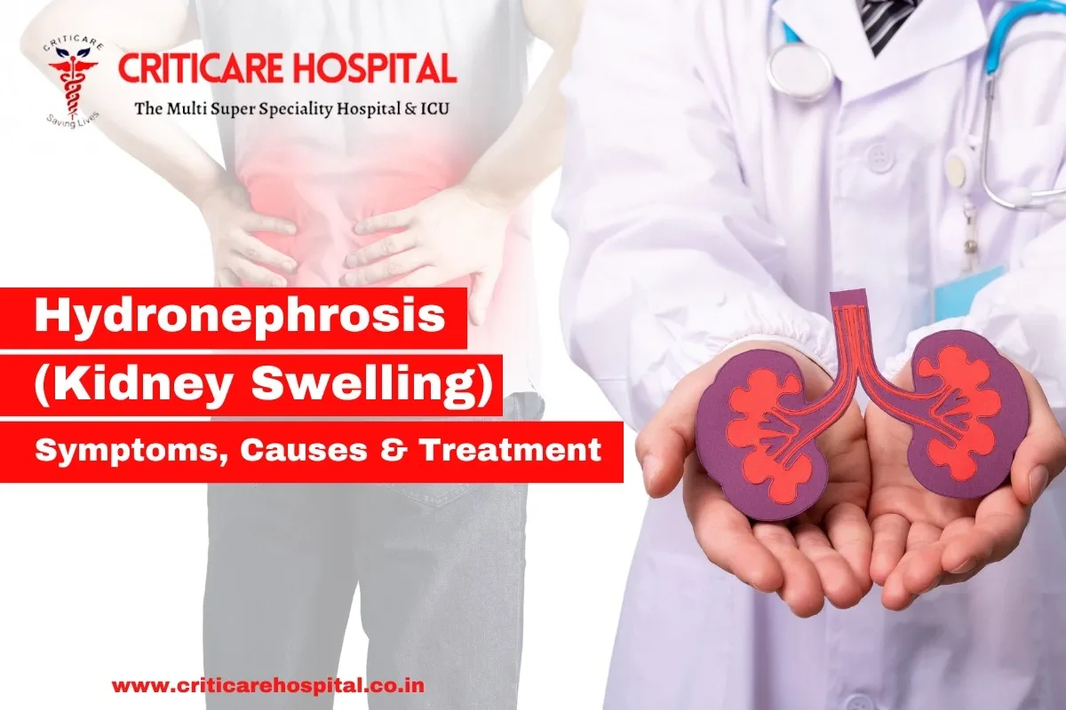 Hydronephrosis (Kidney Swelling): Symptoms, Causes & Treatment