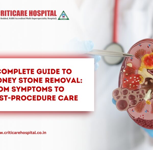 Guide to Kidney Stone